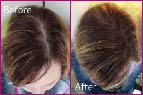 medicines to regrow hair